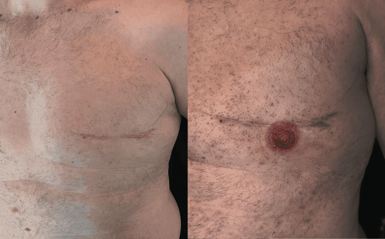 Realistische tepel en areola tattoo na borstamputatie.